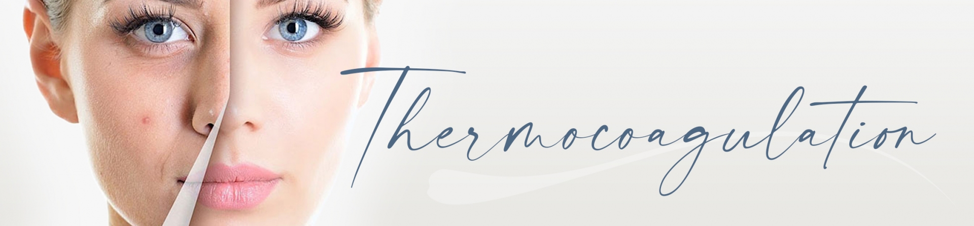 Thermocoagulation